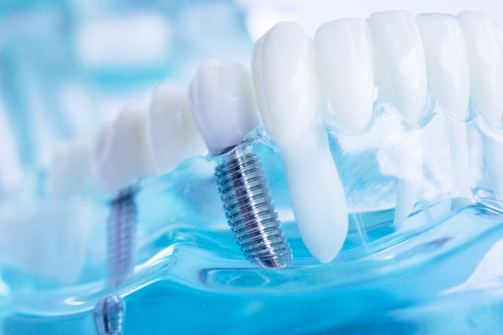 How To Care For New Dental Implants