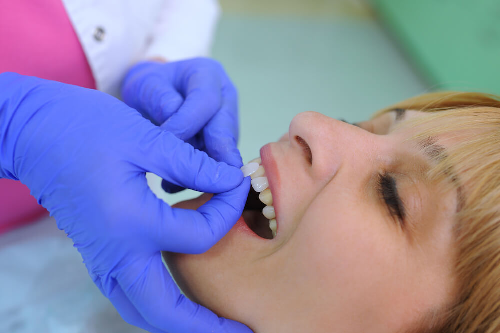 What to expect after getting dental veneers